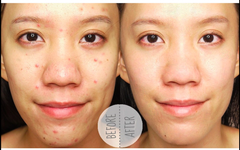 Gel Trị Mụn Ẩn, Mụn Viêm, Mụn Đầu Đen Klenzit MS 15g