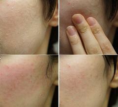 Sữa Rửa Mặt Isis Pharma Giảm Nhờn Và Ngăn Ngừa Mụn Teen Derm Gel 150ml