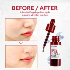 (Size nhỏ) Tinh Chất Tẩy Da Chết Hóa Học So’Natural Red Peel Tingle Serum 11ml