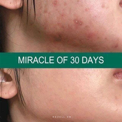 Kem dưỡng trị mụn SOME BY MI AHA-BHA-PHA 30 Days Miracle Cream 60g - HNK