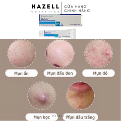 Gel trị mụn - Adapalene gel adaferin 0.1 (15g)