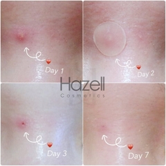 Miếng dán mụn COSRX Acne Pimple Master Patch