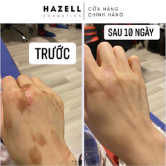 Kem trị sẹo Contractubex Merz
