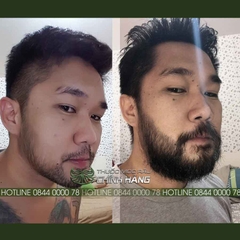 Minoxidil 10% mintop