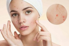 TỪ A – Z VỀ CÁCH CHĂM SÓC DA KHÔ MỤN HIỆU QUẢ