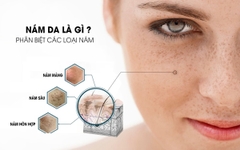 Chăm sóc da nám như thế nào cho phù hợp?