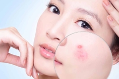 Nắm rõ nguyên nhân khiến mặt nổi mụn ở từng vùng và cách ngăn ngừa giúp da khỏe mạnh
