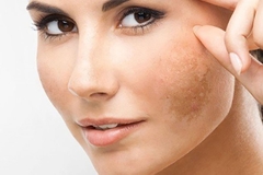 4 bước chăm da giúp xóa mờ và ngăn chặn đốm nâu hiệu quả