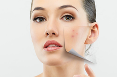 Sữa rửa mặt lý tưởng cho da mụn