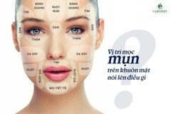 Vị trí mụn ẩn trên trán và những chỗ khác cảnh báo điều gì về cơ thể bạn?