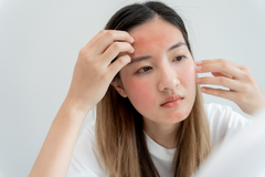 VIÊM DA TIẾT BÃ: NGUYÊN NHÂN, TRIỆU CHỨNG VÀ CÁCH ĐIỀU TRỊ HIỆU QUẢ