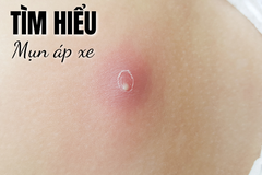 TÌM HIỂU: Cách Nhận Biết Và Đối Phó Với Mụn Áp Xe!