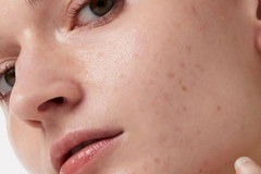 Da Thâm Mụn Cần Gì Để Đều Màu An Toàn?