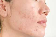 Vì Sao Mụn Thường Nổi Nhiều Hơn Trước Kỳ Kinh?
