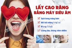 Tranh Lấy cao răng bằng máy siêu âm