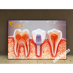 Tranh Implant nha khoa- MS27