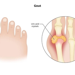 Biểu hiện thường gặp của bệnh gout cấp và cách xử trí