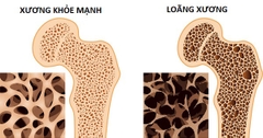 Chế độ ăn cho người bệnh loãng xương