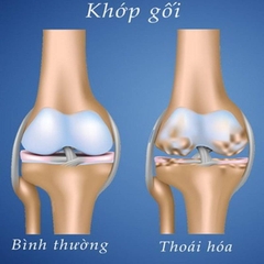 Tại sao sụn khớp bị bào mòn lão hóa?