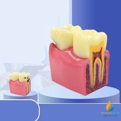 Mô hình giải phẫu răng sâu và răng không sâu, mô hình cấu trúc răng sâu