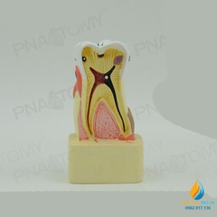 Mô hình giải phẫu bệnh lý sâu răng, mô hình cấu trúc sâu răng, nhựa PVC cao cấp