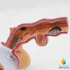 Mô hình giải phẫu bệnh lý thực quản ở người, nhựa PVC cao cấp