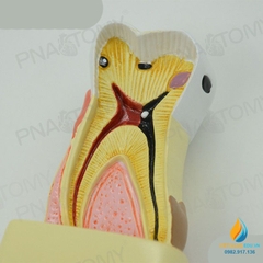 Mô hình giải phẫu bệnh lý sâu răng, mô hình cấu trúc sâu răng, nhựa PVC cao cấp