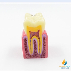 Mô hình giải phẫu răng sâu và răng không sâu, mô hình cấu trúc răng sâu