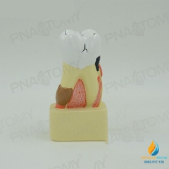 Mô hình giải phẫu bệnh lý sâu răng, mô hình cấu trúc sâu răng, nhựa PVC cao cấp