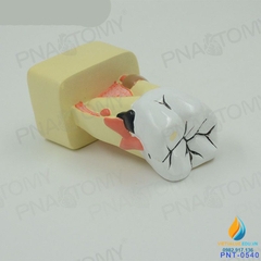 Mô hình giải phẫu bệnh lý sâu răng, mô hình cấu trúc sâu răng, nhựa PVC cao cấp