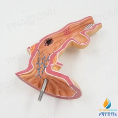Mô hình giải phẫu bệnh lý thực quản ở người, nhựa PVC cao cấp