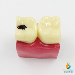 Mô hình giải phẫu răng sâu và răng không sâu, mô hình cấu trúc răng sâu