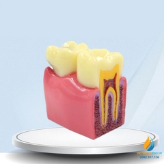 Mô hình giải phẫu răng sâu và răng không sâu, mô hình cấu trúc răng sâu