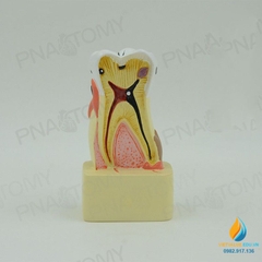 Mô hình giải phẫu bệnh lý sâu răng, mô hình cấu trúc sâu răng, nhựa PVC cao cấp