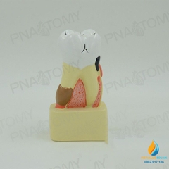 Mô hình giải phẫu bệnh lý sâu răng, mô hình cấu trúc sâu răng, nhựa PVC cao cấp