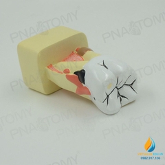 Mô hình giải phẫu bệnh lý sâu răng, mô hình cấu trúc sâu răng, nhựa PVC cao cấp