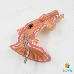Mô hình giải phẫu bệnh lý thực quản ở người, nhựa PVC cao cấp