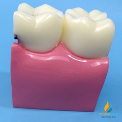 Mô hình cắt ngang của răng người, kích thước 55x75x85mm, chất liệu nhựa PVC