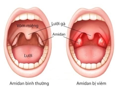 Rau trai vị thuốc hỗ trợ điều trị viêm họng hiệu quả