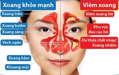 Tham khảo cách phòng và điều trị bệnh viêm xoang mạn tính hiệu quả bằng đông  tây y kết hợp