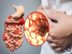 Đâu là các triệu chứng bệnh Crohn bạn cần biết?