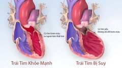 Đông y điều trị bệnh loạn nhịp tim