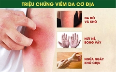 Bài thuốc chữa bệnh viêm da cơ địa hiệu quả