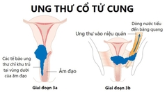 Ung thư cổ tử cung giai đoạn 2 nên làm gì?