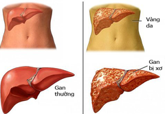 Xơ gan cổ trướng