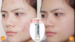 Kem trị mụn Dalacin T Gel 1%