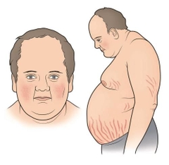 co-the-ngu-ng-hoa-n-toa-n-glucocorticoid-o-be-nh-nhan-lupus-duo-c-khong