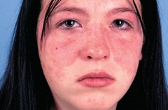 lupus-ban-do-he-thong-overview