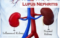 benh-than-lupus