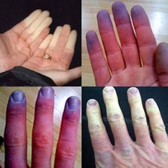 hoi-chung-raynaud